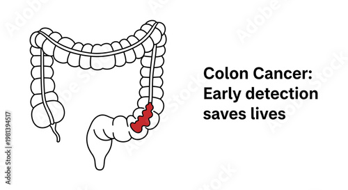 Colon cancer awareness illustration with large intestine anatomy and early detection message.