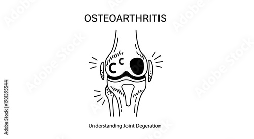 Osteoarthritis medical illustration of a knee joint showing bone degeneration and inflammation.
