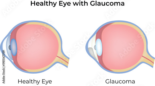Glaucoma and Healthy Eye Comparison Illustration