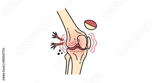 A detailed medical illustration depicts a human knee joint from a lateral perspective showing significant inflammation and joint pain against a clean white background.