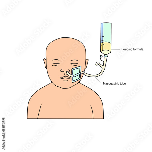 Feeding a Newborn Through a Nasogastric Tube