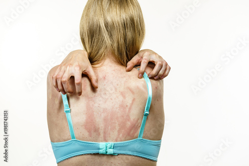 Woman scratching her itchy back with allergy rash