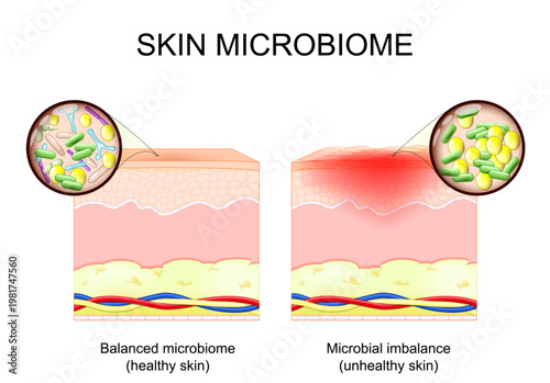 Skin microbiome. Close-up of Microbial imbalance and Balanced microbiome