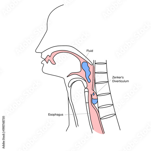 Zenker’s Diverticulum Medical Illustration