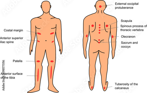 Common Pressure Ulcer Sites