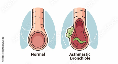 Side-by-side comparison of a normal bronchiole and an asthmatic one