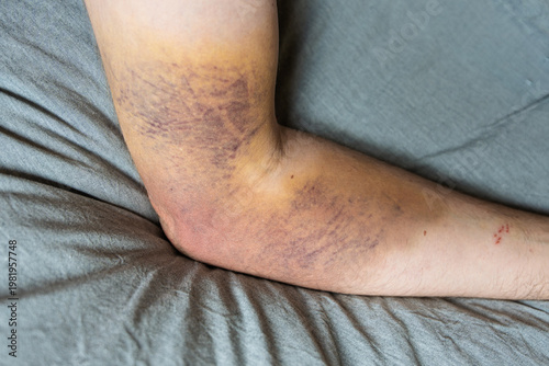 Bruised Arm After Blood Draw at Elbow Medical Close Up