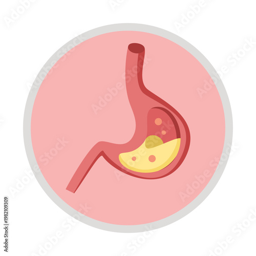 Gastroesophageal reflux disease (GERD) or acid reflux. 