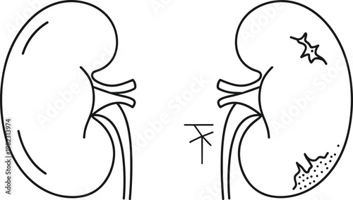 Tableau sur toile Kidney disease vector illustration showing damaged renal organs with cracks ston