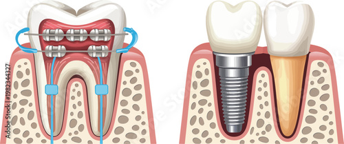 Dental implants and orthodontic braces, teeth restoration, oral surgery, metal brackets