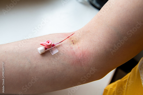 Tableau sur toile Human arm with visible marks immediately after intravenous cannula needle remova