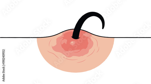Close up illustration of ingrown hair on skin with red inflammation and curved black hair