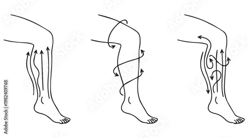 Medical illustration of leg movement disorders and abnormal gait patterns in black and white