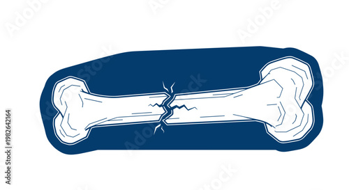 Illustration of a fractured bone highlighted by a focused ray of blue light, set against a stark white background