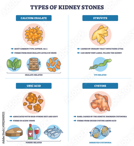 Kidney stones types chart showing calcium oxalate, uric acid, struvite, and cystine, icons of stones, labels, and arrows explain causes and diet links. Outline diagram