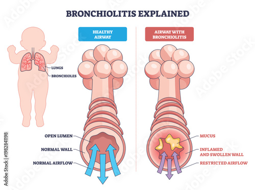 Bronchiolitis explained contrasts healthy and inflamed airways, highlighting lungs, bronchioles, and mucus blockage to show restricted airflow in infants. Outline diagram