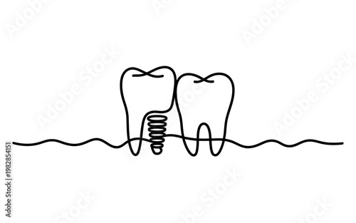 A simple line drawing of two teeth with a dental implant