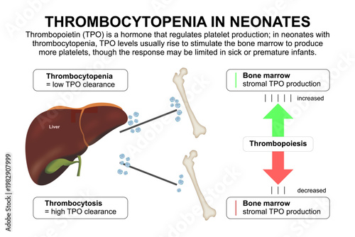 Thrombocytopenia in Neonates