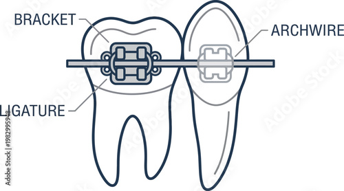 Orthodontic braces ligature archwire medical line art vector illustration