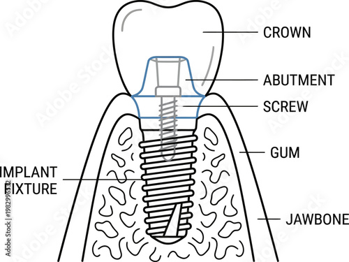 Dental implant structure anatomy medical line art vector illustration
