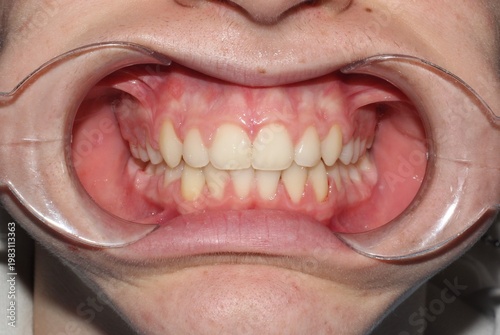 Extreme Close-Up of Patient Smile with Dental Cheek Retractors at Dentist Clinic