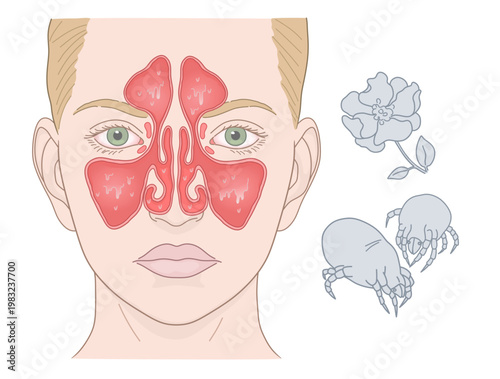 Medical Illustration of Allergic Rhinitis: Nasal Sinus Inflammation and Common Triggers (Dust Mites and Pollen). ENT Series.