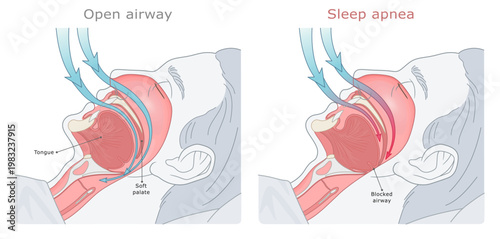 Medical illustration of obstructive sleep apnea, showing the tongue blocking the airway in the throat. ENT Series.