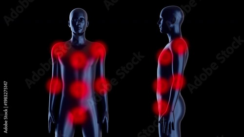 Full body 3D medical animation showing multiple inflammation zones from front and side views. Represents complex medical conditions, total body pain or musculoskeletal system failure.