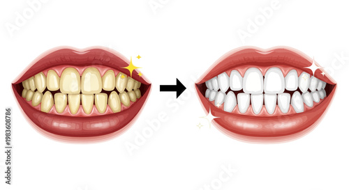 Realistic illustration comparing discolored teeth before and after professional whitening treatment, showcasing a bright, healthy smile