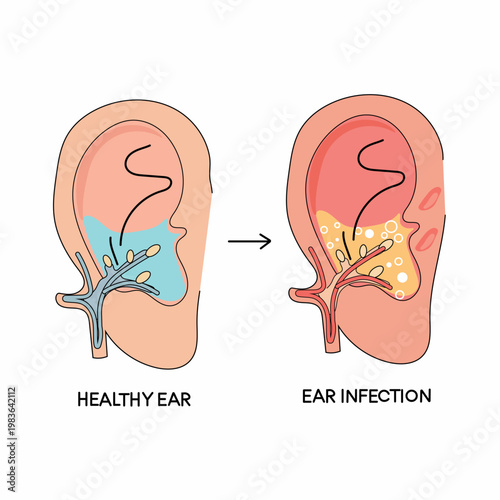 Ear anatomy diagram showing infection versus normal healthy ear