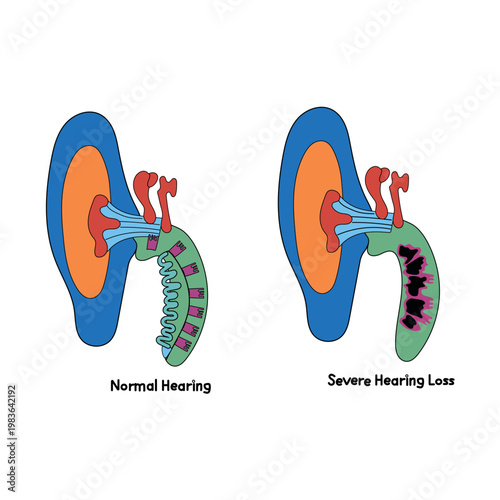 Ear anatomy showing normal hearing and severe loss