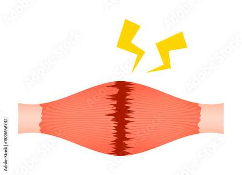 肉離れ（完全断裂）