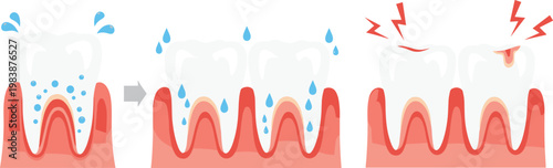 Tooth Decay Stages Illustration Set Showing Plaque Buildup Gum Infection and Pain for Dental Healthcare Education and Medical Design