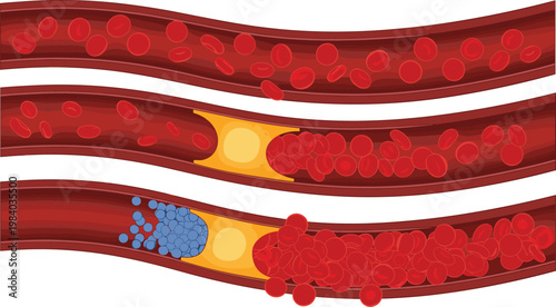 Artery Blockage Illustration with Blood Clot and Cholesterol Plaque Showing Reduced Blood Flow Cardiovascular Disease Medical Vector Diagram Set