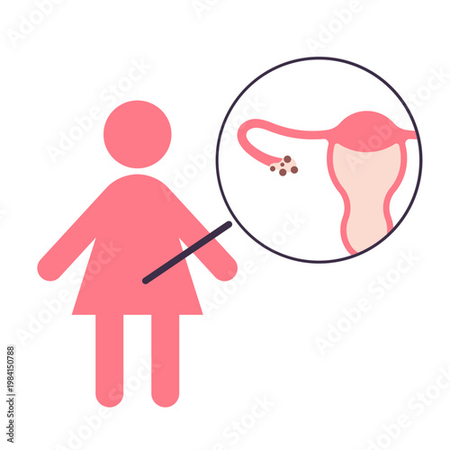 Medical illustration of endometriosis in female reproductive system
