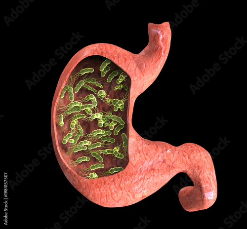 Helicobacter pylori bacteria attacking the human stomach