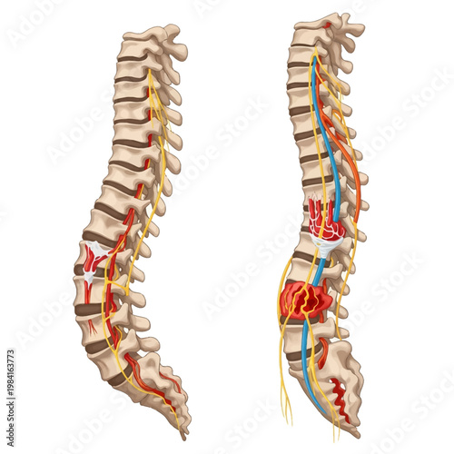 Medical illustration comparing a normal human spine with a pathological vertebral column showing nerve compression, spinal tumor, herniated disc, and vascular damage on white background.