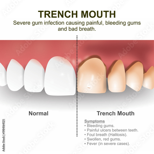 Trench Mouth Teeth Infographic flashcard