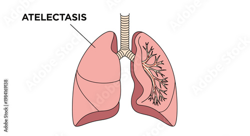 Anatomical diagram of human lungs highlighting the condition of atelectasis with text labels on a white background.