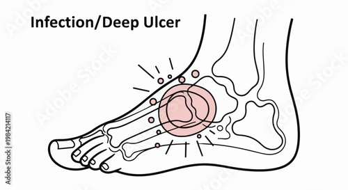 Medical illustration of a foot showing bones, infection, and deep ulcer