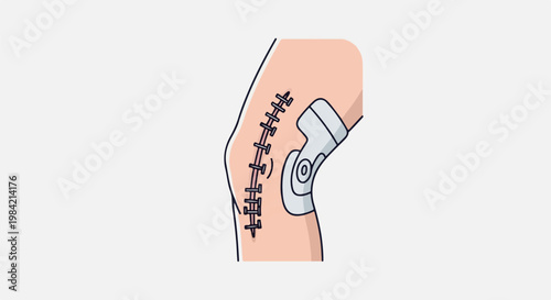 Medical illustration of a stitched leg wound with a brace