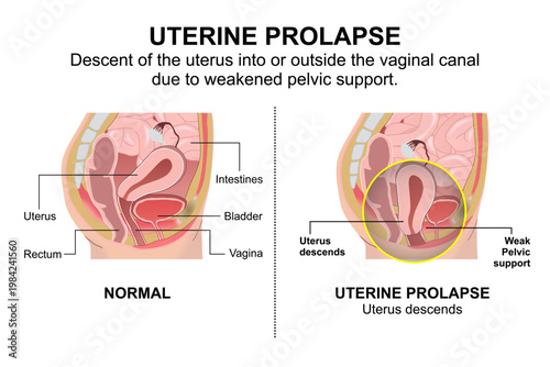 Uterine Prolapse weak pelvic support illustration