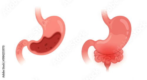 Medical vector illustration comparing healthy human stomach anatomy with a cross-section of an unhealthy stomach showing signs of inflammation, ulcers, or gastritis on a white background.