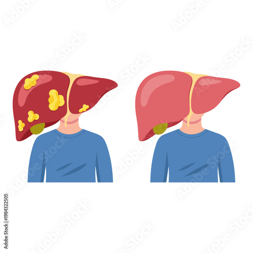 Comparison of healthy and diseased liver conditions in human figures Vector, illustration