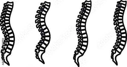 Four human spine illustrations in different scoliosis stages  medical anatomy reference