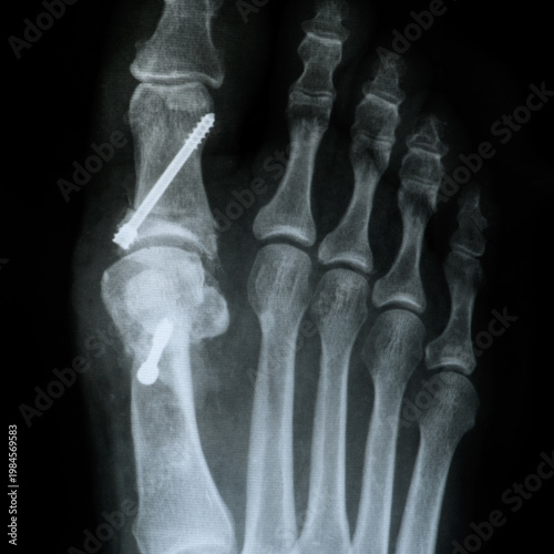 Close up X-ray film front foot after Hallux Valgus surgery