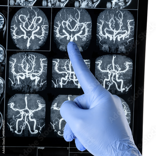 Hand in blue medicine glove pointsin front of image of magnetic resonance imaging (MRI) scan brain blood vessels