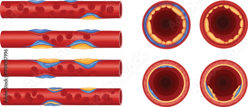 Artery Blockage Progression Illustration with Cholesterol Plaque Buildup and Blood Flow Restriction Cross Section Cardiovascular Disease Medical Vector Diagram Set