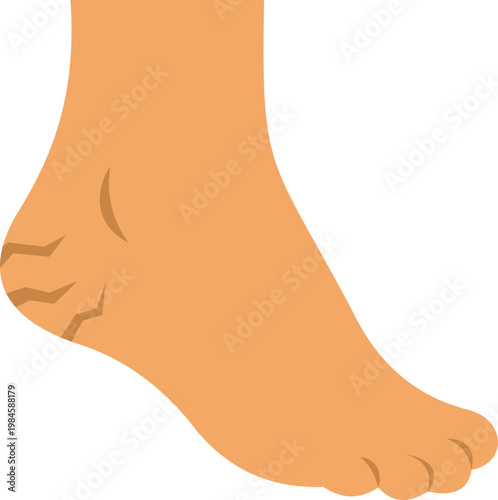 Illustration of a human foot showing dry cracked heel representing skin care and health issues