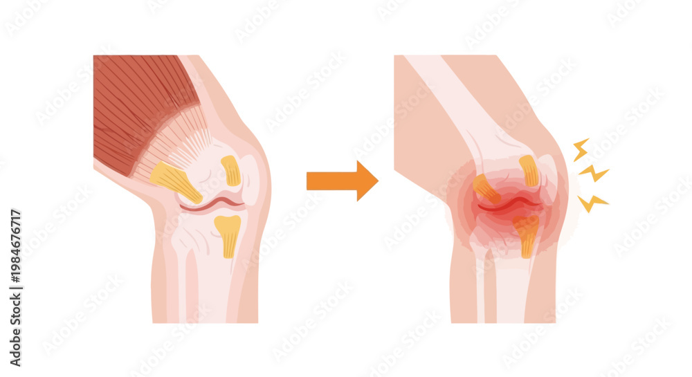 Εκτύπωση καμβά Illustration showing a healthy knee joint transitioning to an inflamed and painf